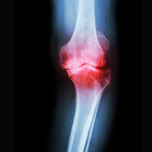 Understanding Knee Bone On Bone Pain mLab
