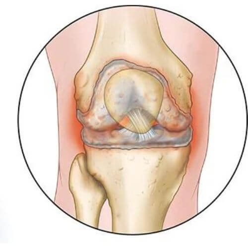 Enduring Solutions for Knee Pain and Osteoarthritis: Your Guide to Long-Term Relief