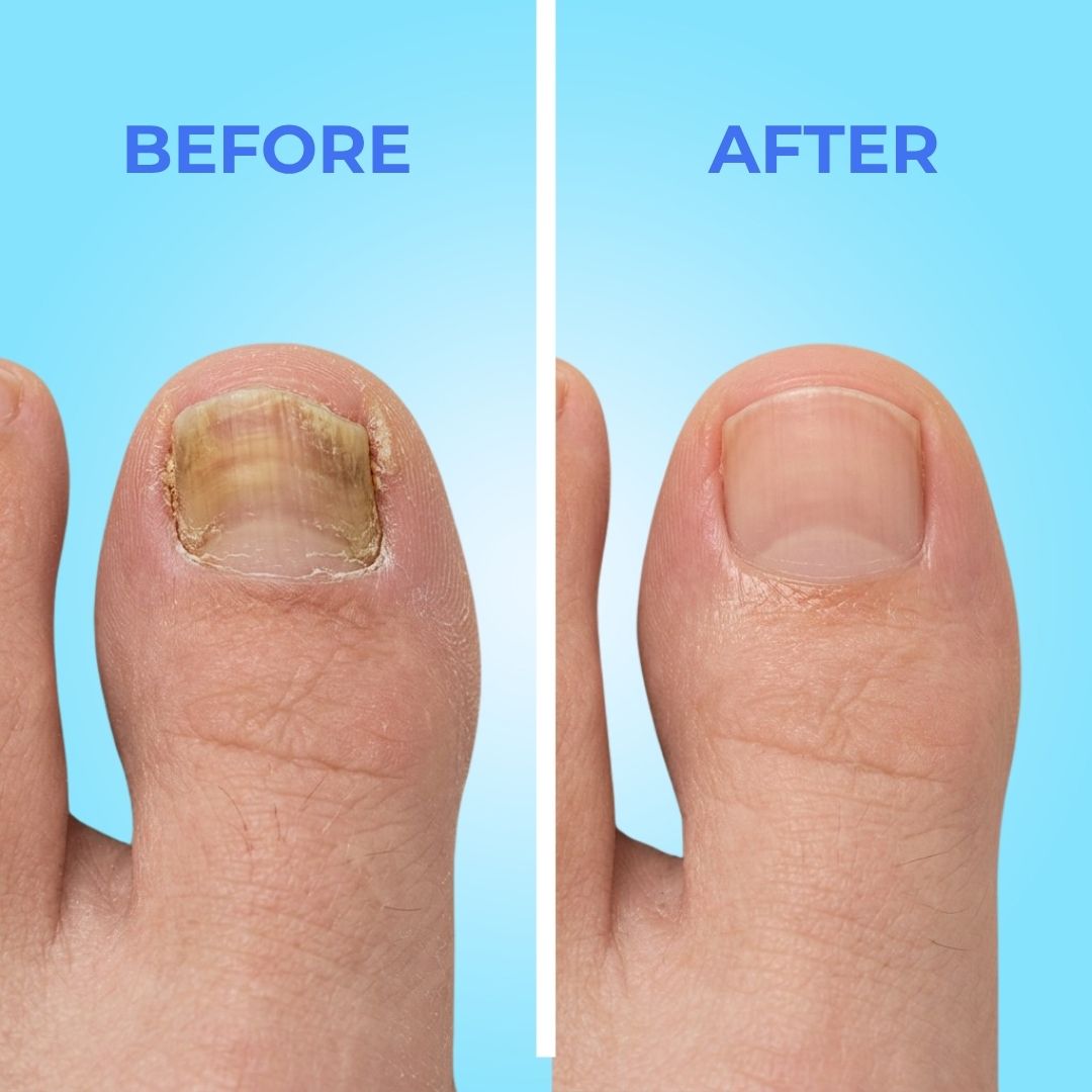 OnyPatch™ Fungal Nail Renewal Patches